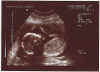 11th scan of Connall